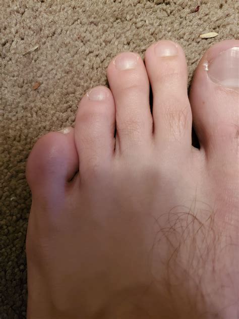 Can anyone tell me what's wrong with my pinky toe? : r/Podiatry