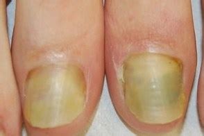 Синдром зеленого ногтя (green nail syndrome) - Клинические рекомендации