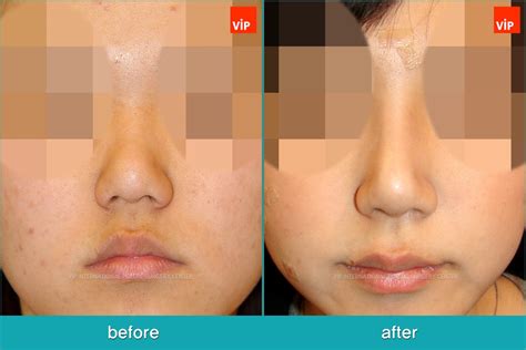 nose surgery    vip plastic surgery korea