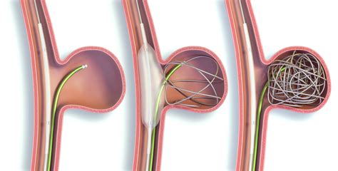coil embolization ruptured aneurysm  ben vincent blog