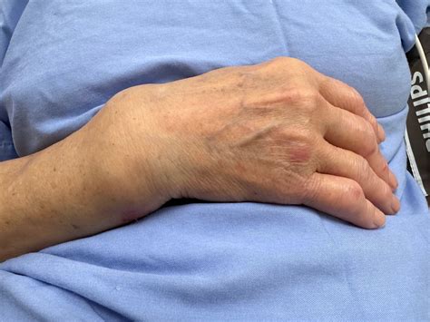 Distal Radius Wrist Fractures Treatment in Singapore | By Dr Jacqueline Tan