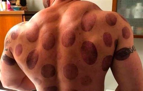cupping marks explained duration significance colors removal