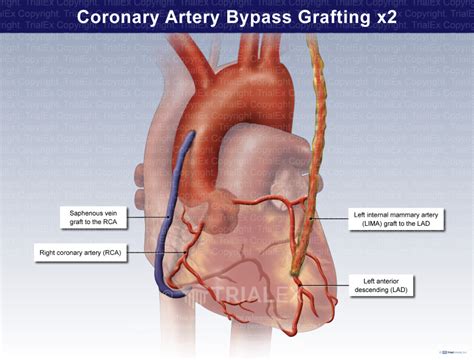 coronary artery bypass grafting  trialquest