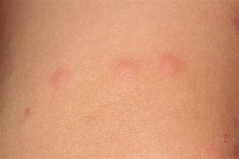 Types of bug bites in bed - occupyDer