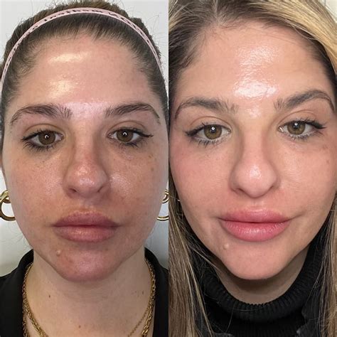 levisa lazer: Before & After Photos That Will Amaze You - h0g4nu3