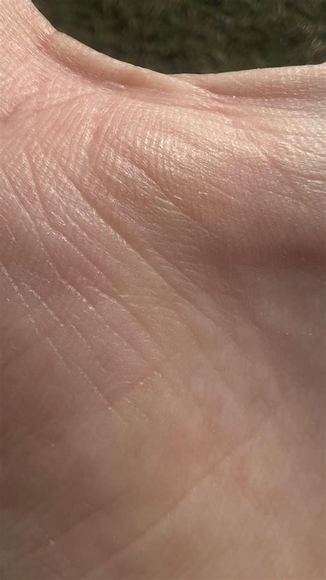 Does this look like scabies? : r/scabies