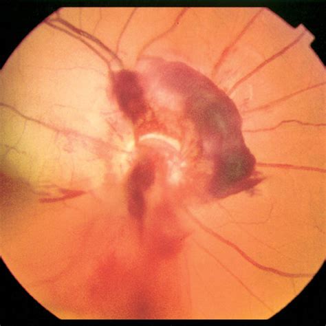 (PDF) Accidental self-inflicted optic nerve head avulsion