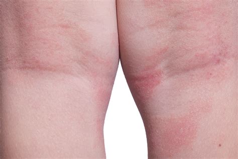 Eczema | Reno Tahoe Dermatology | Best Reno Dermatologist