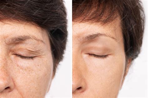Inchaço Antes E Depois - Rosto de mulher idosa com inchaço sob os olhos e rugas nas pálpebras ...