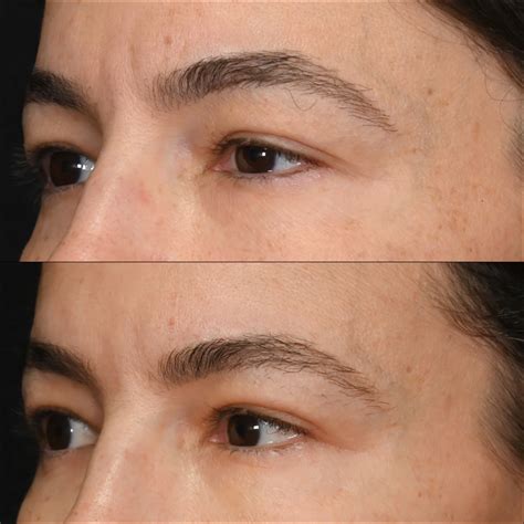 Revision Surgery Before & After Photos | Flora Levin MD