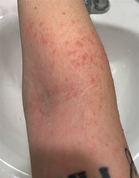 Eczema On Upper Arms Eczema Herpeticum: Pictures, Stages And Treatment