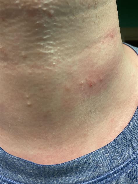 What Skin Rash Looks Like Pimples at Jennifer Pardue blog