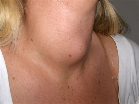 goitre thyroid enlargement nodules hyperthyroidism britannica