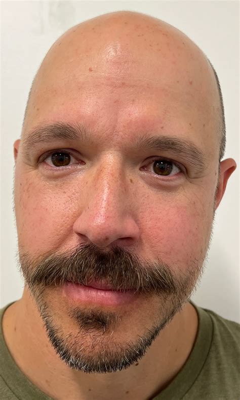 Rosacea Treatment | Fairview Dermatology