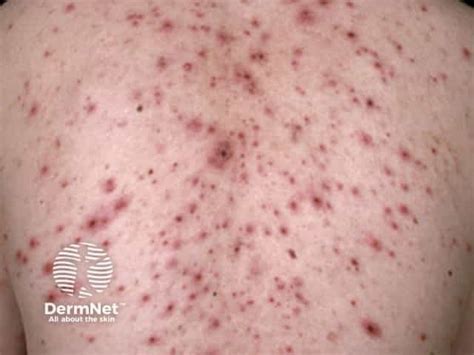 varicella rash images