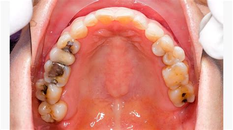 Cavity Filling Before And After