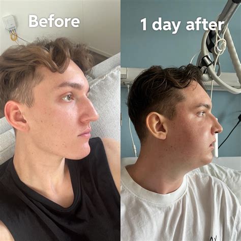 1 day after double jaw surgery : r/jawsurgery