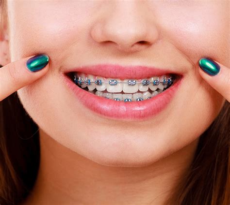 braces  missing teeth allen tx hanson orthodontics  allen
