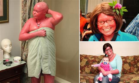 Harlequin Ichthyosis Survivor EXPECTING THE MOST UNEXPECTED – A