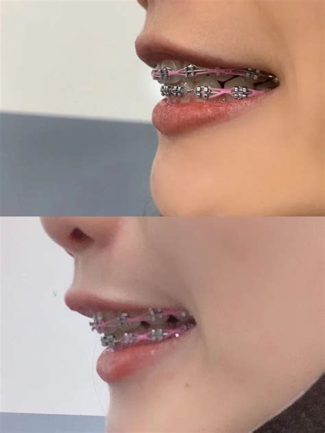 Pin en Silver Smile close-up | Brackets dentales, Frenillos dentales ...