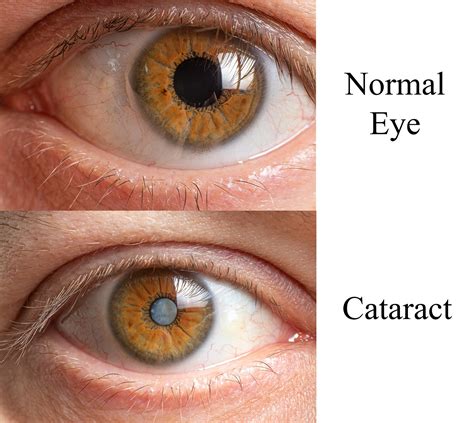 Eye Cataract Without