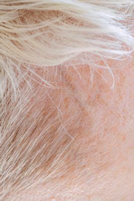 Soothing the Scalp: Effective Strategies for Managing Scalp Psoriasis - Latest Business, Fashion ...