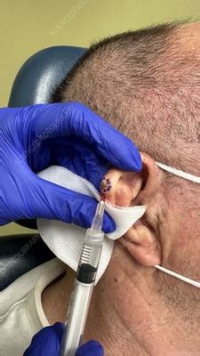 shave biopsy  squamous cell carcinoma stock image