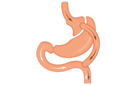 exploring  types  gastric bypass surgery