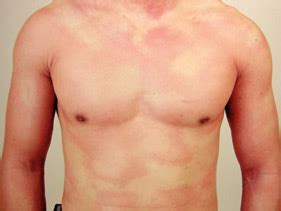 Exercise Induced Urticaria Causes – Online degrees