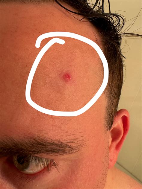 Is this a cherry angioma : r/AusSkincare