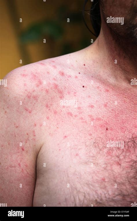 scalp sun rash  gustavo christensen blog