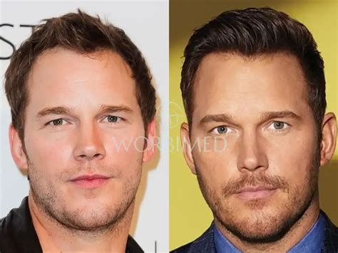 Chris Pratt Hair Transplant | Before and After