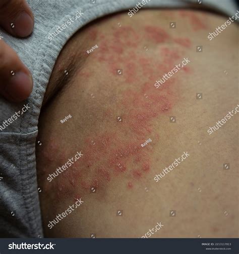 Tinea Cruris Ring Worm Infection On Stock Photo 2213117813 | Shutterstock