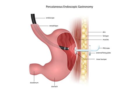 Feeding Tube - Kingwood GI - Gastroenterology Clinic