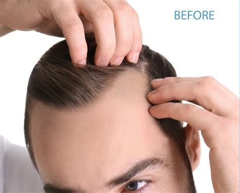 Hair Growth Treatment | Advanced PainCare and BioHealth Institute