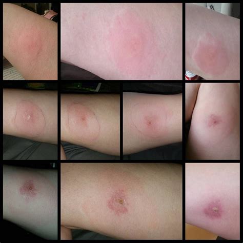 These pictures of the most common spider bites will help you figure out ...