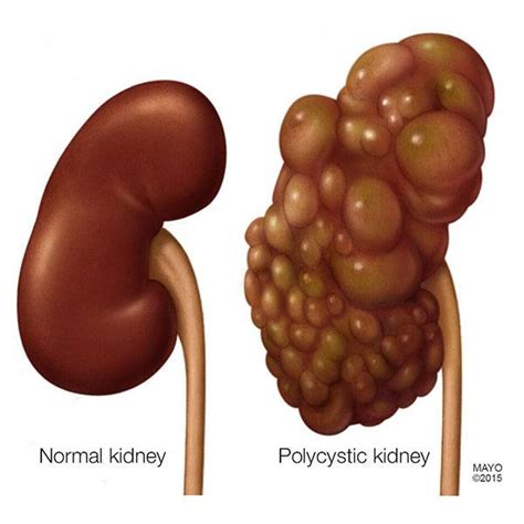 tuesday   paying attention  diet   prevent gout flare
