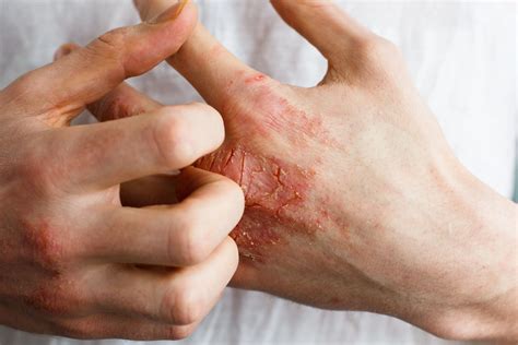 Hand Dermatitis | Dermatologist In Baton Rouge, LA | Atlas Dermatology