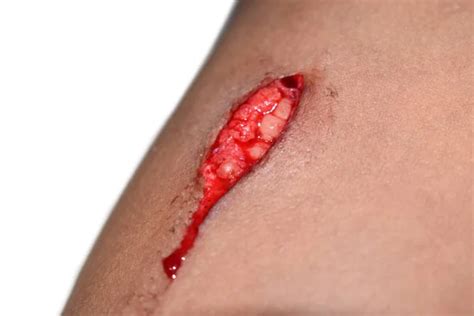 wound healing stages stock  royalty  wound healing stages