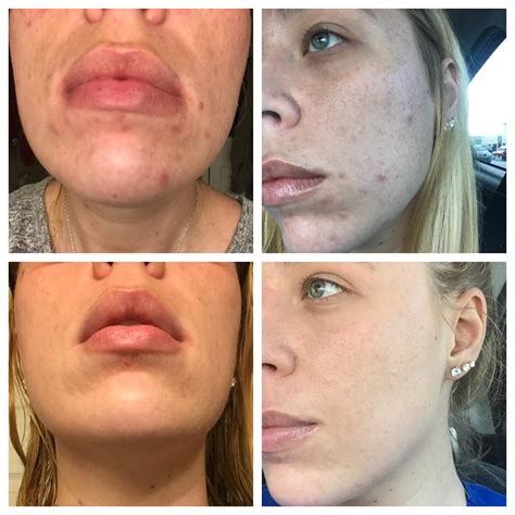 160 best Clindamycin images on Pholder | Tretinoin, Acne and Skincare