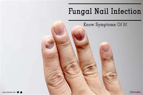 Early Fungal Fingernail | atelier-yuwa.ciao.jp