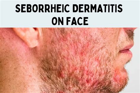 Seborrheic Dermatitis on Face: Treatment, Causes, Symptoms