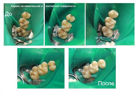 Лечение кариеса в городе Раменское цена от 1600 руб - «New Smile»