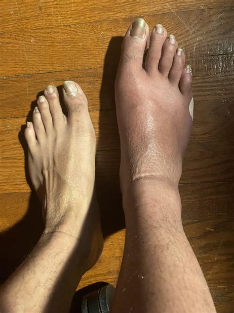 Help I have CRPS in my right foot any advice. I’ve done Physical