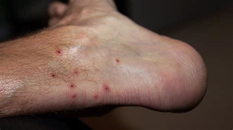 Cheyletiellosis Humans