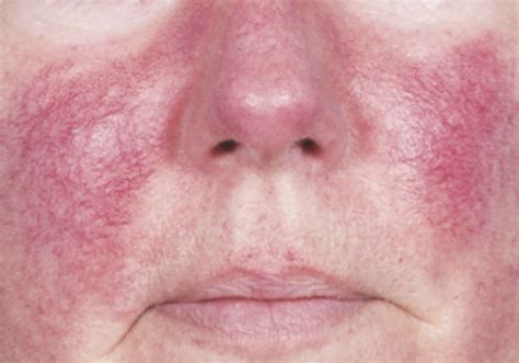 Rosacea