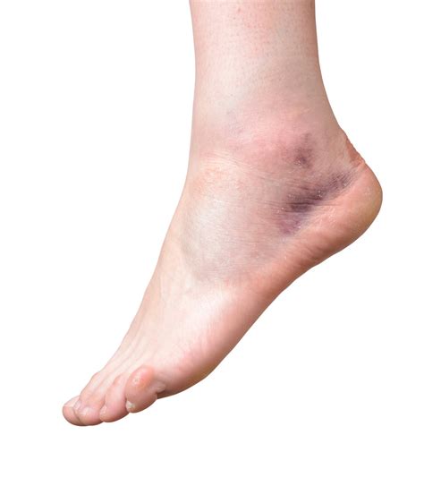 Sprained Ankle — FOOT & ANKLE CENTERS