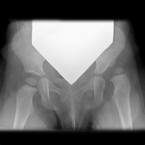 diagnosing ddh dont forget  bubbles