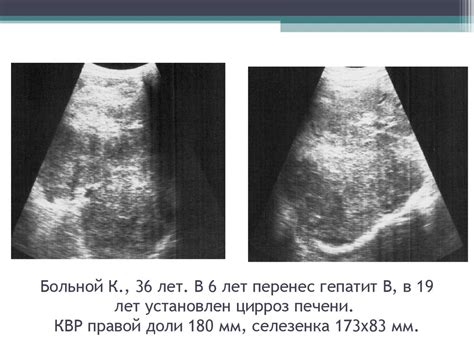 Ультразвуковая диагностика заболеваний печени - презентация онлайн