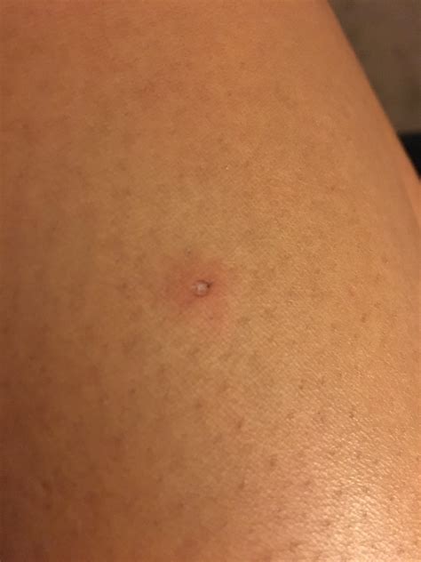 Mysterious bump on leg. It doesn't hurt or itch. It had a scab that
